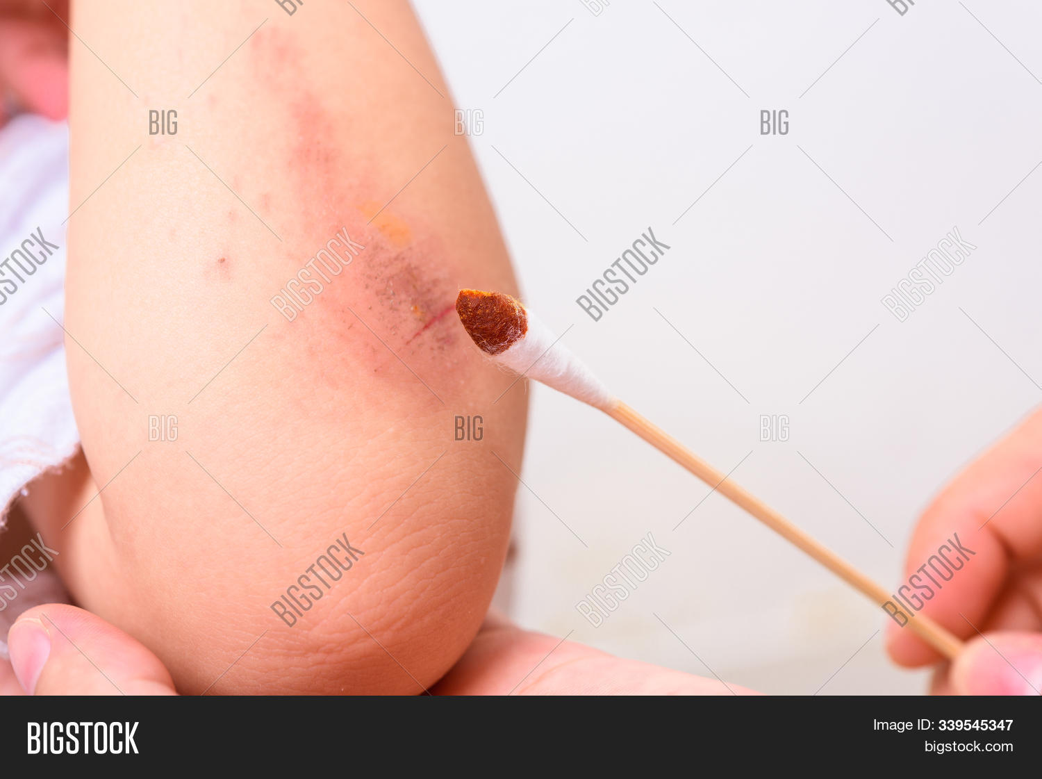 2-3,abrasion,accident,aid,arm,asian,bandage,blood,boy,care,child,clean,concept,cry,dermatitis,dressing,dry,elbow,fall,first,hand,heal,health,hospital,human,hurt,infected,inflammation,injured,injury,itchy,kid,knee,leg,lesion,man,medical,medicine,pain,people,person,plaster,scab,scratch,skin,son,thailand,treatment,wound