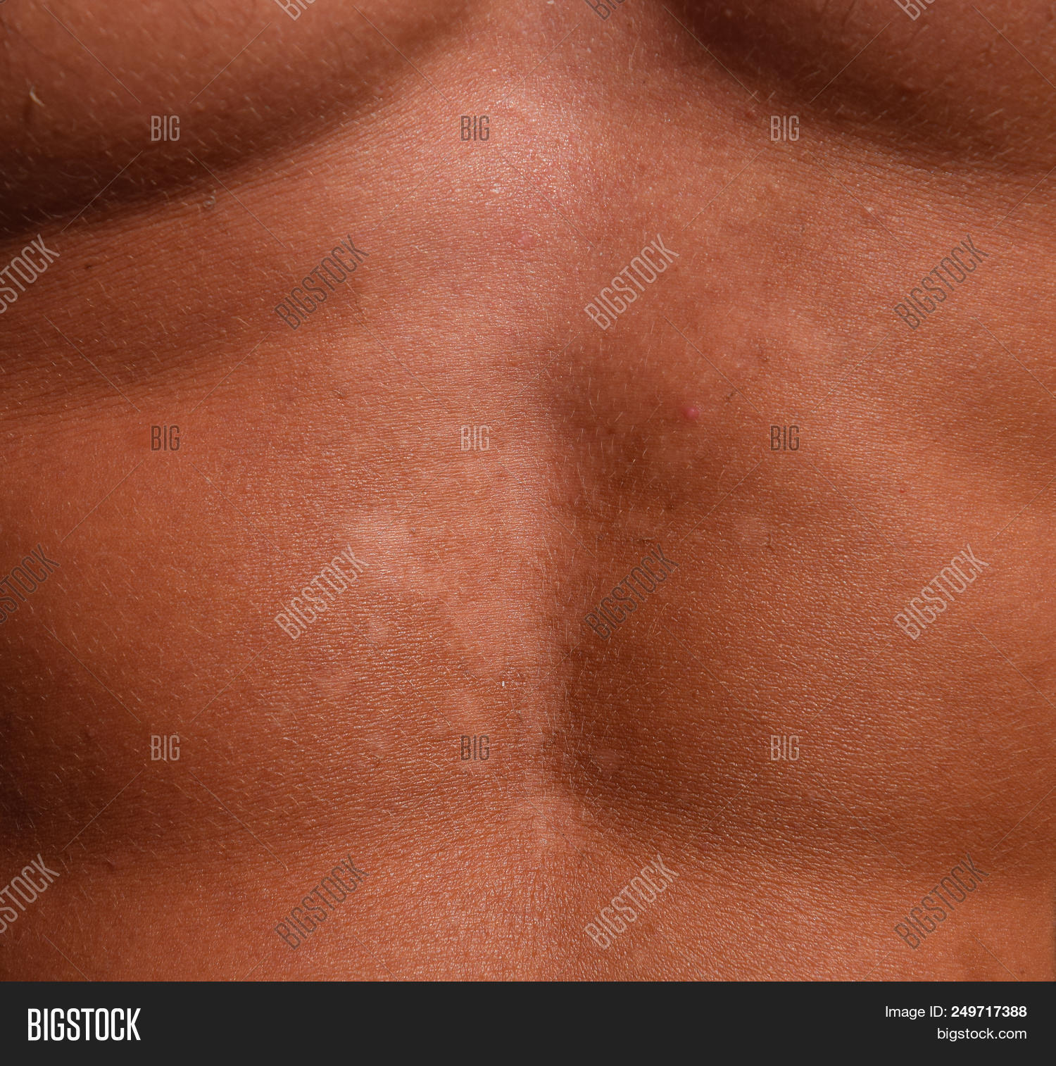 allergy,back,beach,blister,blistered,body,burn,care,change,damage,danger,dangerous,dermatitis,dermis,disease,dry,dump,effect,exfoliation,fungus,hand,healing,health,heat,inflammation,leprosy,male,man,moisturiser,muscles,ozone,peel,peeling,psoriasis,radiation,redness,shabby,shell,shoulder,skin,summer,sun,sunbath,sunburn,sunscreen,suntan,swim,unhealthy,young