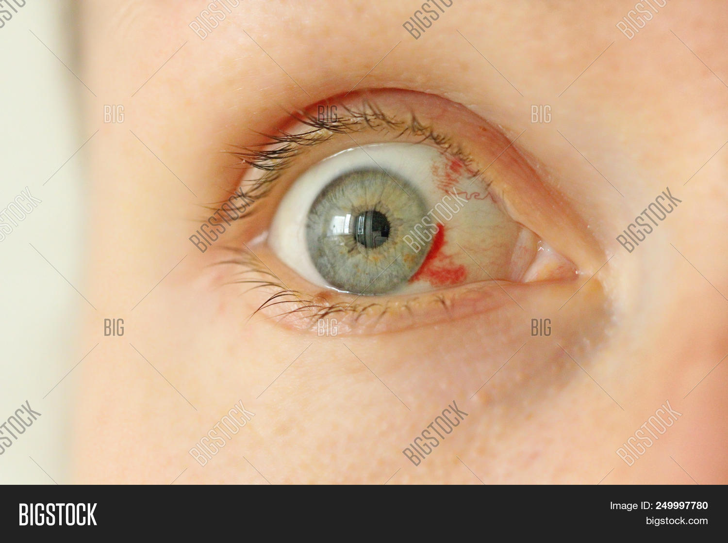 Bloodshot Eye. Woman With Burst Blood Vessel In Eye. Very Red Bloody
