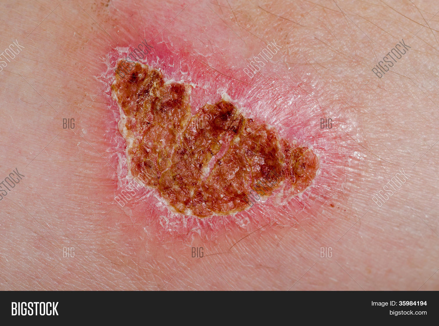 accident,arm,awful,bad,blemish,blood,body,burn,condition,damage,degree,epitel,flesh,foot,harming,heal,health,heat,help,hospital,human,hurt,inability,infection,injury,medical,medicine,pain,painful,people,person,pink,red,scar,second,skin,sore,texture,trauma,treatment,ugly,wound,wrinkles