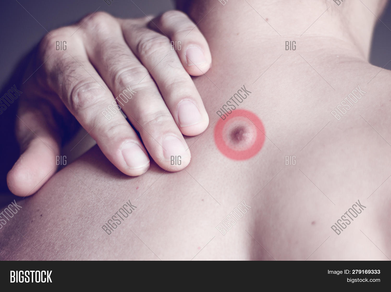 acrochondon,back,benign,birthmark,body,brown,cancer,care,checking,close,closeup,cyst,dermal,dermatologist,dermatology,detail,doctor,eruptions,examination,examine,face,fibroma,fibrosis,hand,health,man,mark,medical,melanoma,mole,papulosa,patient,person,removal,scar,senior,skin,soft,tag,touch,treatment,tumor,up,wart,wrinkles