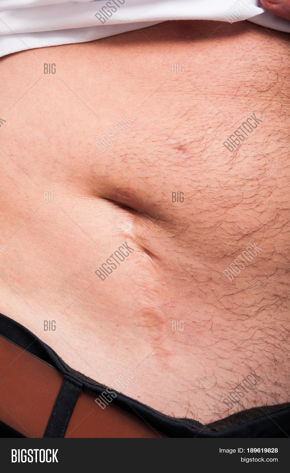 abdomen,abdominal,after.,appendectomy,appendicitis,appendix,belly,big,body,care,deep,healed,health,human,injury,man,medical,medicine,old,operation,pants,patient,removal,scar,side,skin,stomach,surgery,suture,trousers,white
