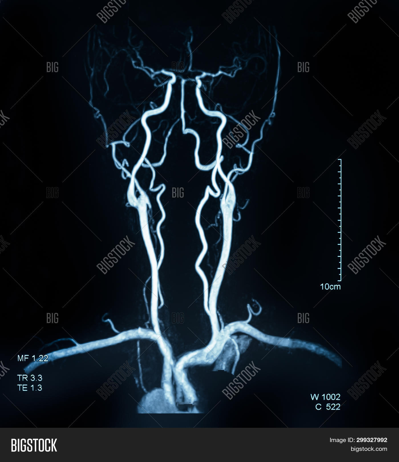 anatomy,aneurysm,angiogram,angiography,artery,brain,cardiologist,care,cerebrovascular,ct,diagnosis,disease,head,headache,health,hospital,human,illness,image,injury,magnetic,medical,medicine,mra,mri,neurosurgery,patient,people,person,radiology,resonance,scan,sick,stroke,study,surgery,vasculature,x-ray